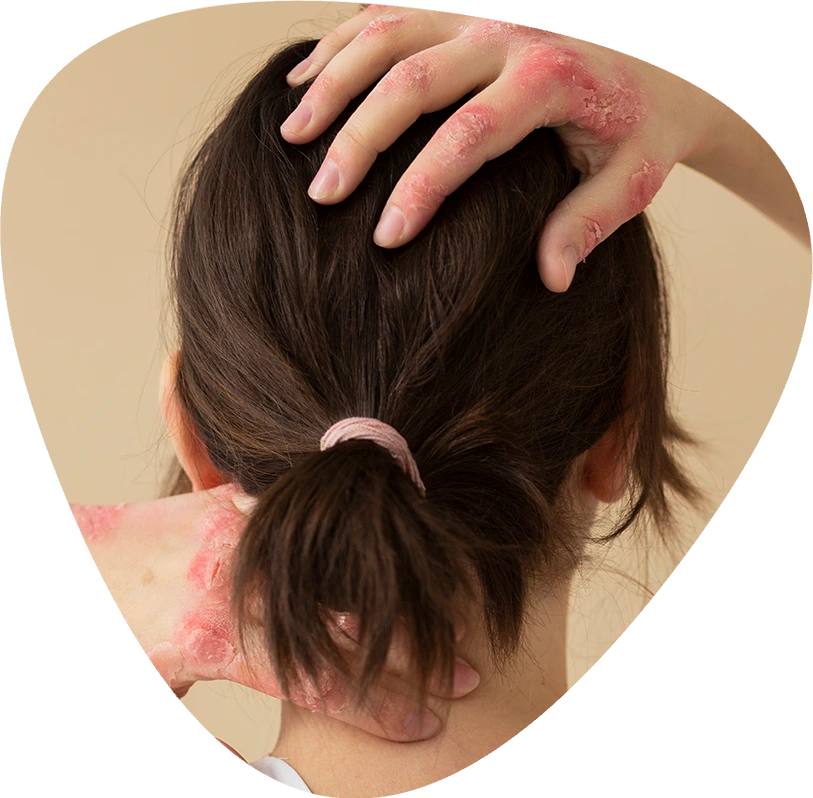 Psoraris Treatment Psoraris Treatment