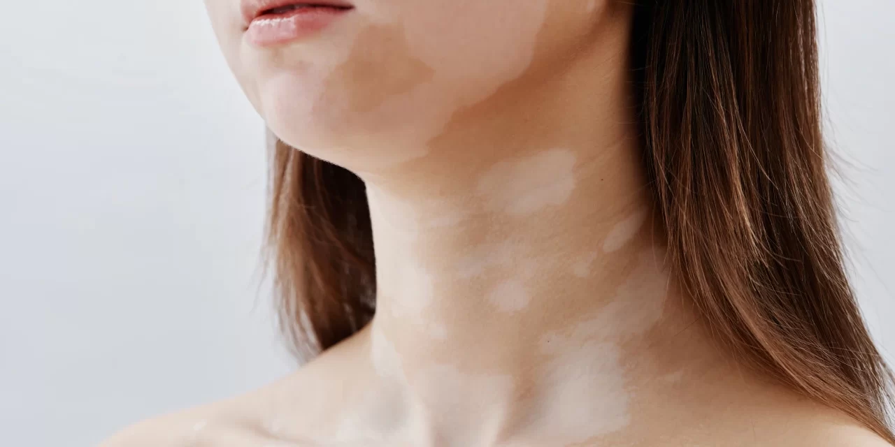 Vitiligo Tedavisi Var Mı? Deri Hastalığının Etkili Tedavi Seçenekleri
