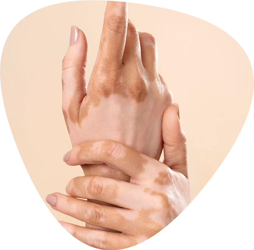 vitiligo behandlung vitiligo behandlung