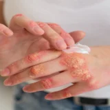 What Should Psoriasis Patients Avoid