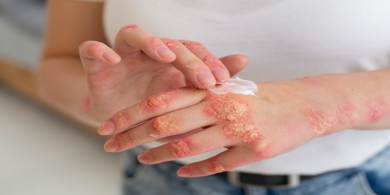 What Should Psoriasis Patients Avoid? Foods to Avoid