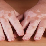 vitiligo