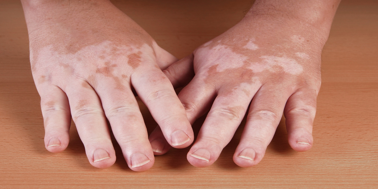 Vitiligo Tamamen Geçer mi? Tedavi Yöntemleri ve Güncel Çözümler
