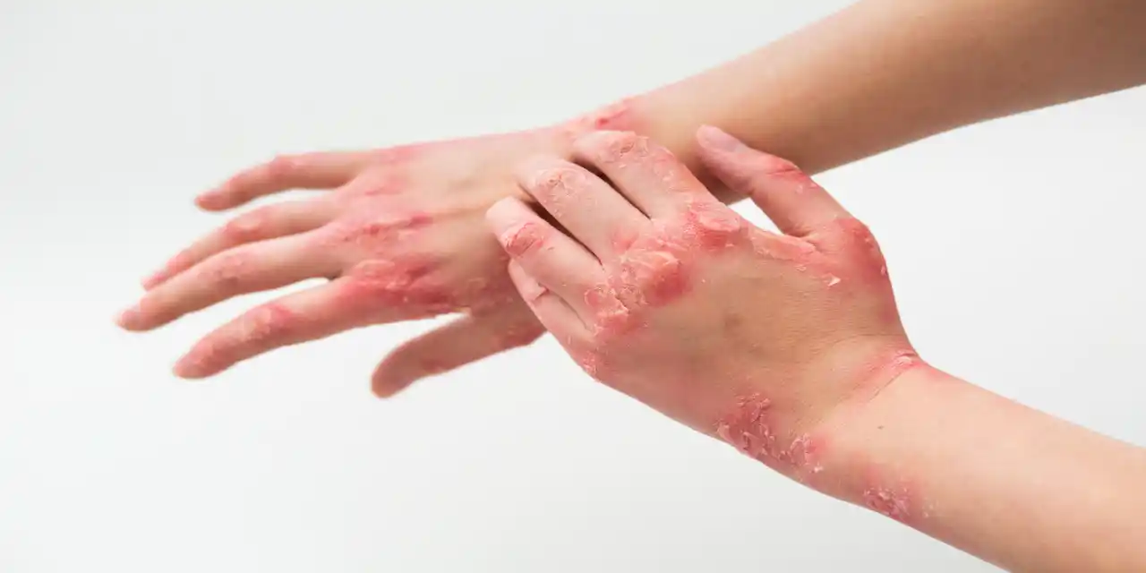 Psoriasis Treatment