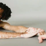 Vitiligo Neden Olur_ s-armin-rimoldi-5304080
