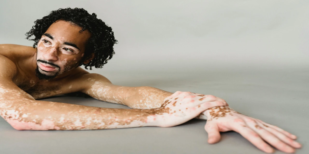 What Causes Vitiligo?